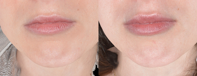 Restylane Refyne before and after photo