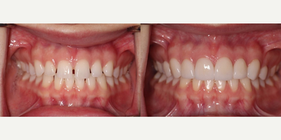 Smile Makeover before and after photo