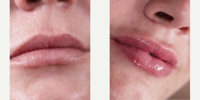 Dermal Fillers before and after photo