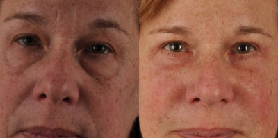 Eyelid Surgery before and after photo
