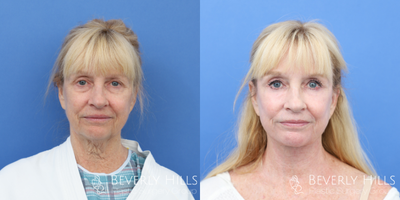 Eyelid Surgery before and after photo