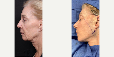 Facelift before and after photo