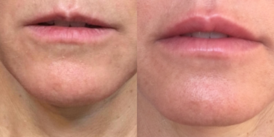 Juvederm before and after photo