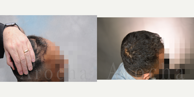 ARTAS Robotic Hair Transplant before and after photo