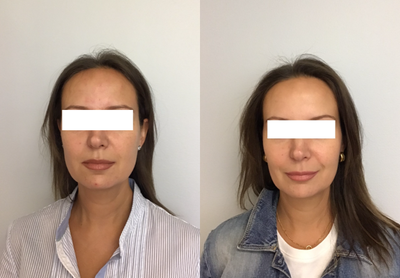 Dysport before and after photo