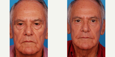 Eyelid Surgery before and after photo