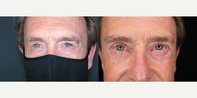 Eyelid Surgery before and after photo