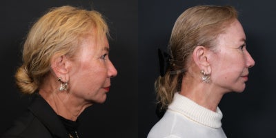 Facelift before and after photo