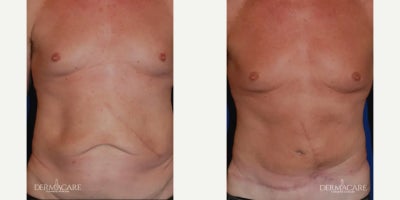 Liposuction before and after photo