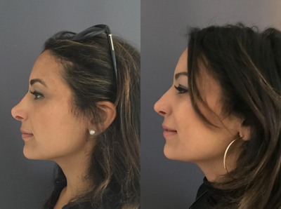 Revision Rhinoplasty before and after photo
