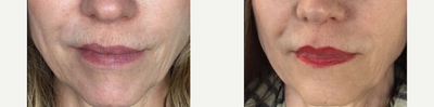 Skin Rejuvenation before and after photo