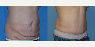 Tummy Tuck before and after photo
