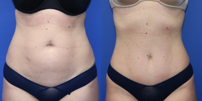 Tummy Tuck before and after photo
