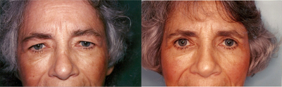 Eyelid Surgery before and after photo