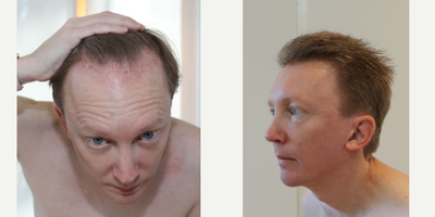 Hair Transplant before and after photo