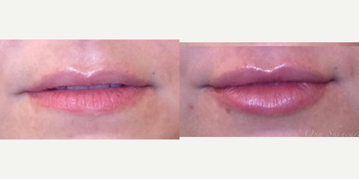 Juvederm before and after photo