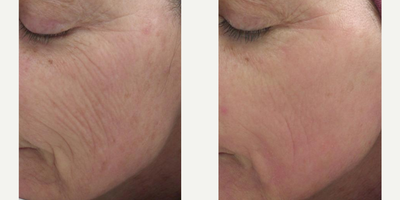 Laser Resurfacing before and after photo