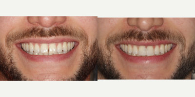 Dental Bonding before and after photo