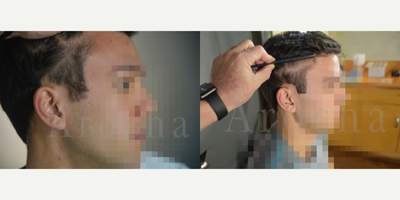 PRP for Hair Loss before and after photo
