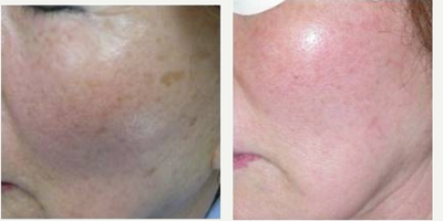 IPL before and after photo