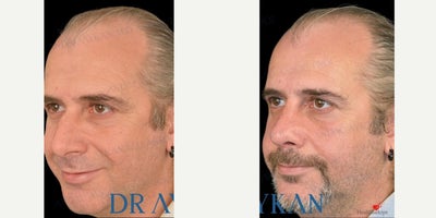 Rhinoplasty before and after photo