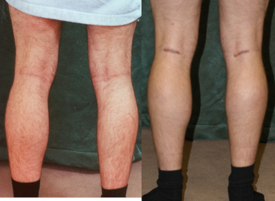 Calf Implant before and after photo