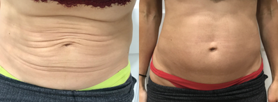 Profound RF before and after photo
