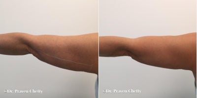 Skin Tightening before and after photo