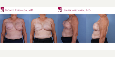 Breast Reconstruction before and after photo