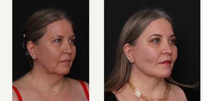 Deep Plane Facelift before and after photo