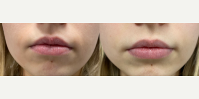 Dermal Fillers before and after photo