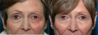Facial Reconstructive Surgery before and after photo