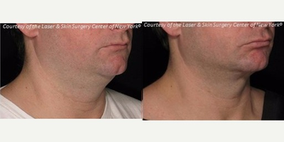 Laser Liposuction before and after photo