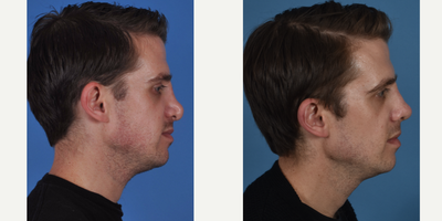 Revision Rhinoplasty before and after photo