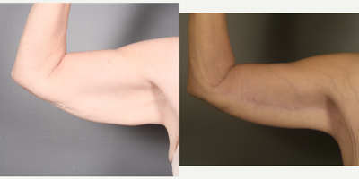 Arm Lift before and after photo