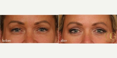 Deep Plane Facelift before and after photo