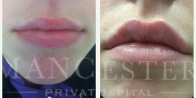 Dermal Fillers before and after photo