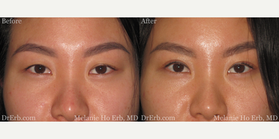 Double Eyelid Surgery before and after photo
