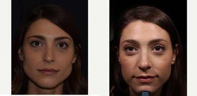 Dysport before and after photo