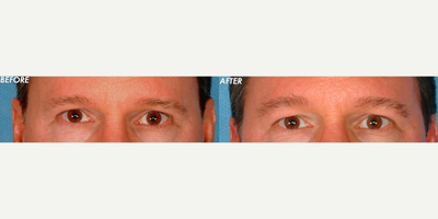 Eyebrow Transplant before and after photo