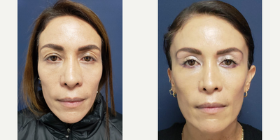 Eyelid Surgery before and after photo