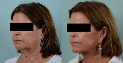 Facelift before and after photo