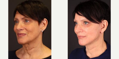before and after image