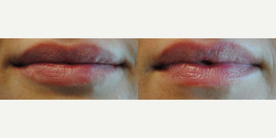 Juvederm before and after photo