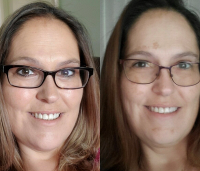 Laser Resurfacing before and after photo