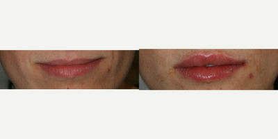 Lip Fillers before and after photo
