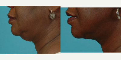 Neck Lift before and after photo