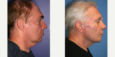 Eyelid Surgery before and after photo