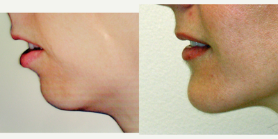 Genioplasty before and after photo