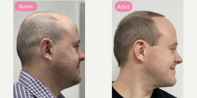 Hair Transplant before and after photo